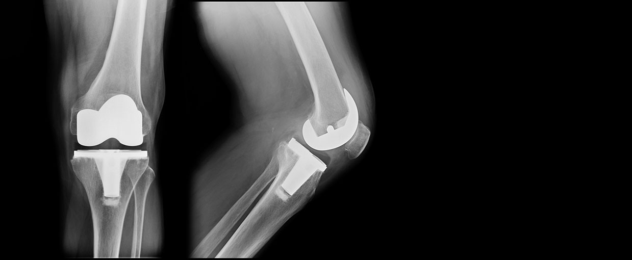 Bilateral Knee Replacement I Orthopaedics I St Vincent’s Private Hospitals